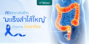 มะเร็งลำไส้ใหญ่ ส่องกล้อง