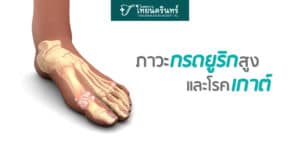 กรดยูริกสูง และโรคเกาต์