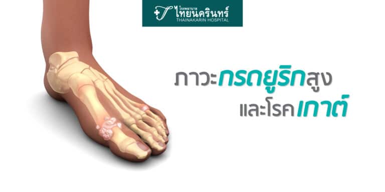 กรดยูริกสูง และโรคเกาต์