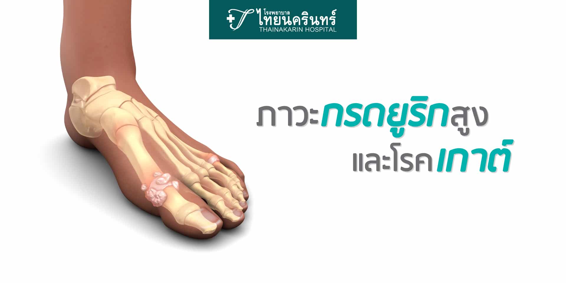 กรดยูริกสูง และโรคเกาต์