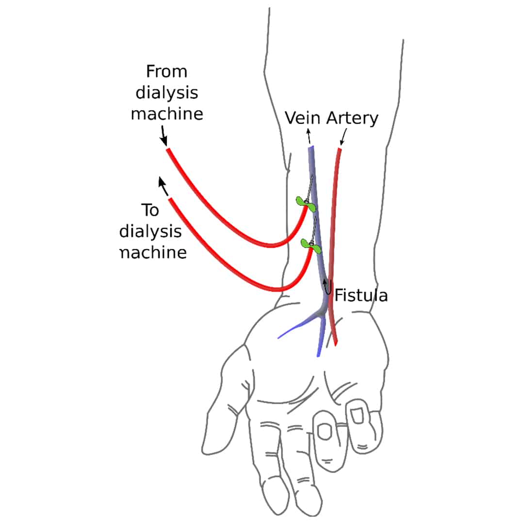 การผ่าตัดเพื่อฟอกเลือด