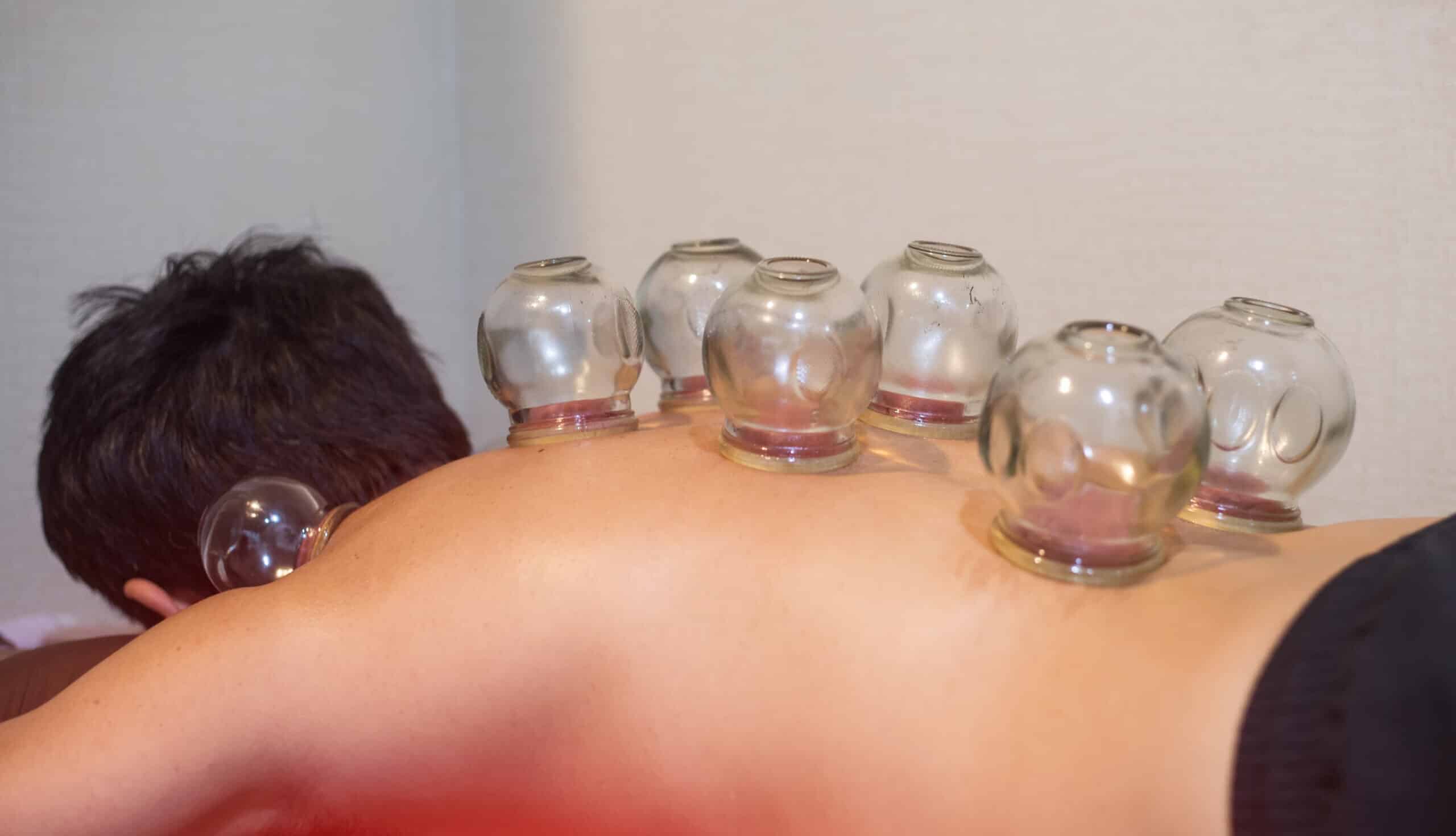 ครอบแก้ว Cupping Therapy