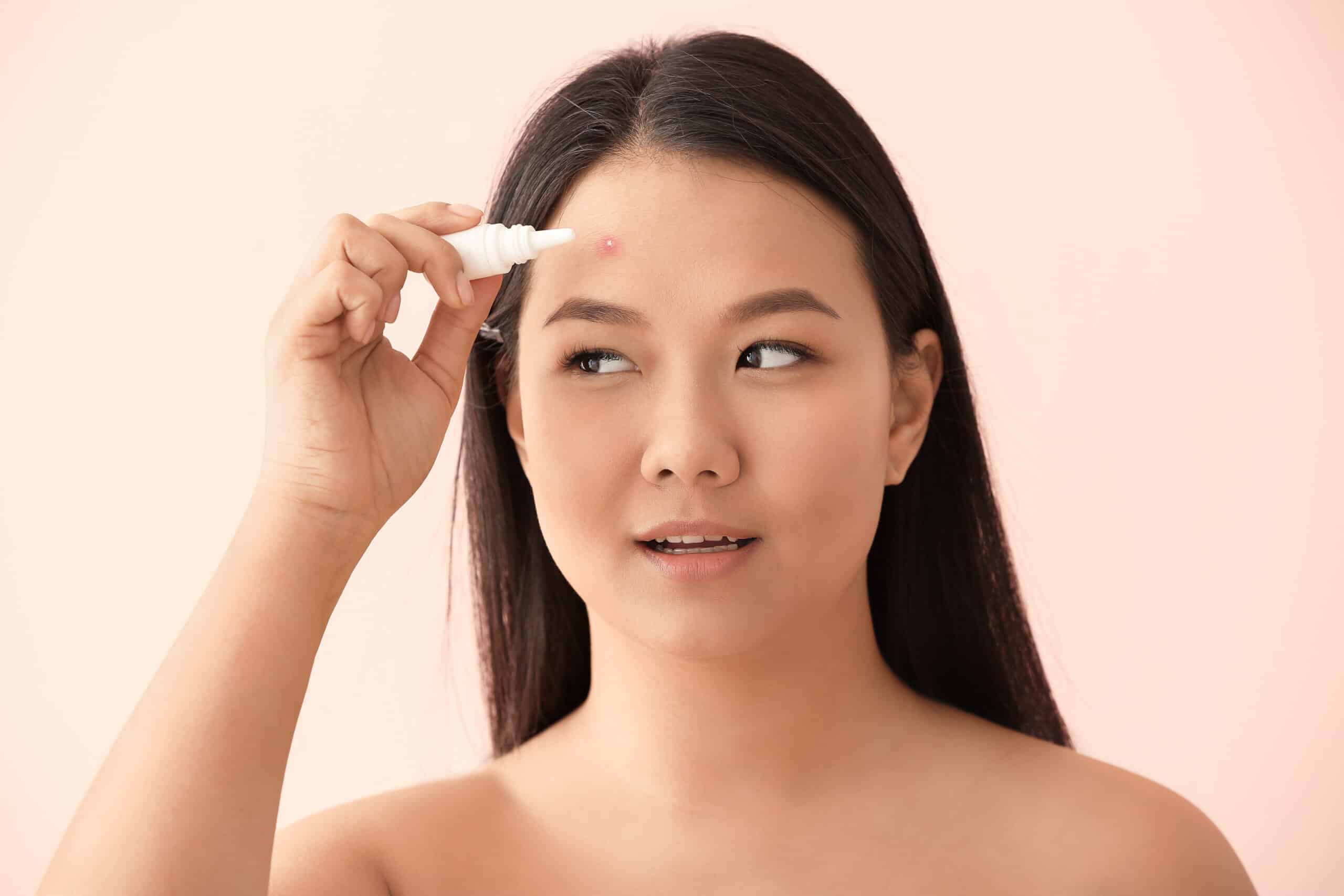 รักษาสิว