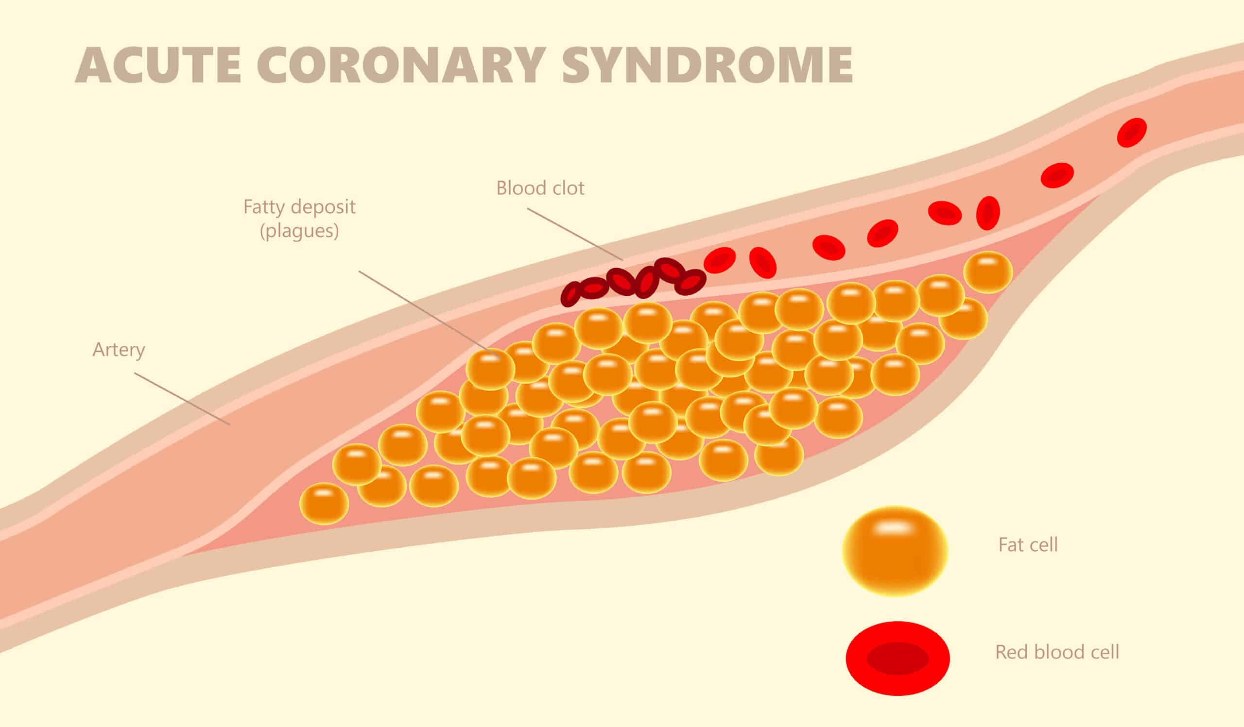 โรคกล้ามเนื้อหัวใจขาดเลือด