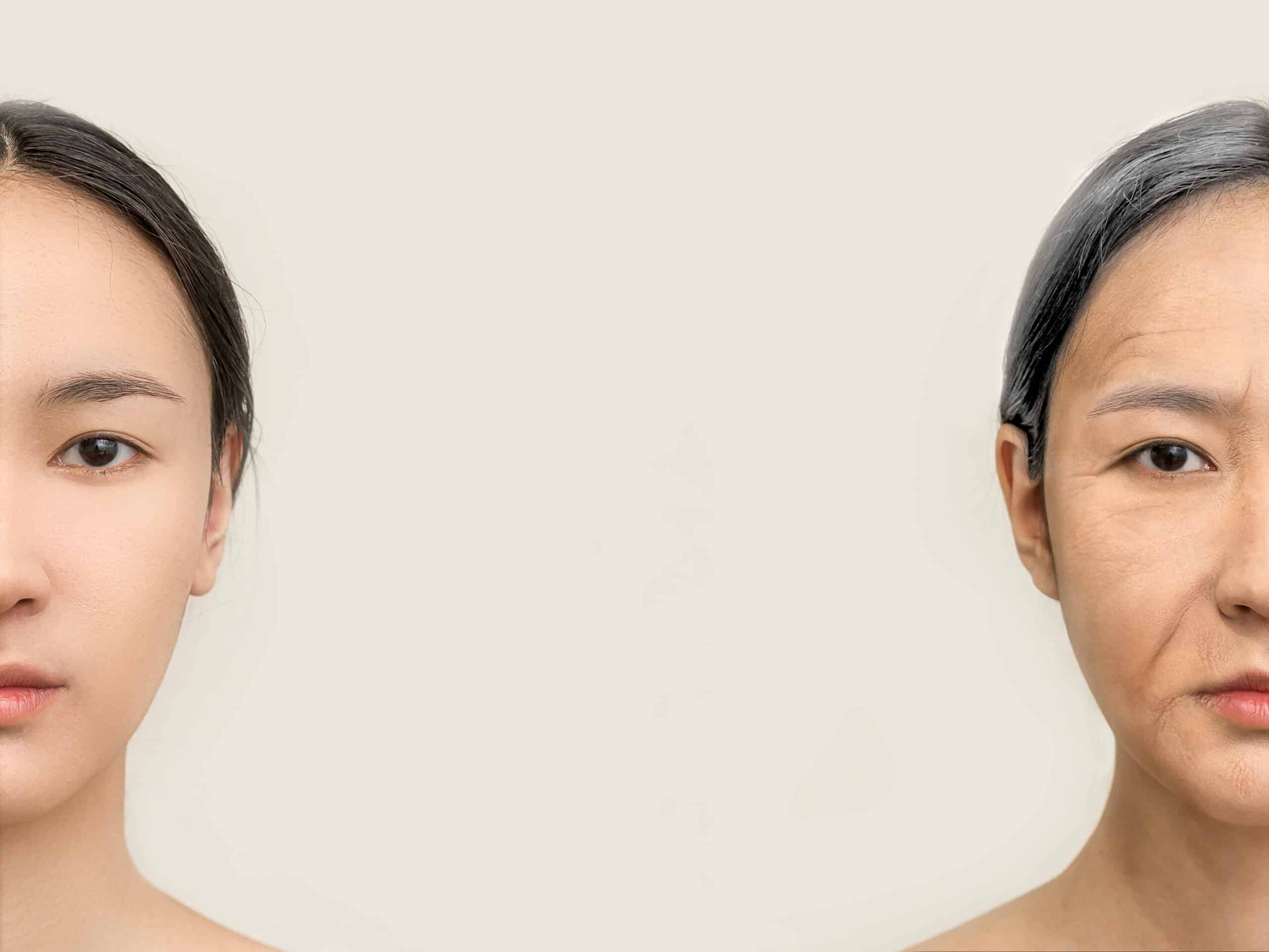 ความแก่ ริ้วรอย (Skin Aging) 