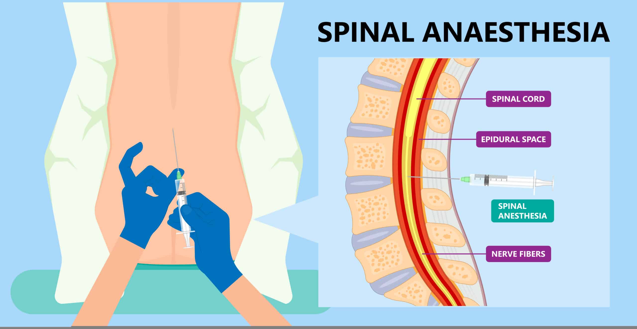 ฉีดยาสเตียรอยด์เข้าโพรงกระดูกสันหลัง