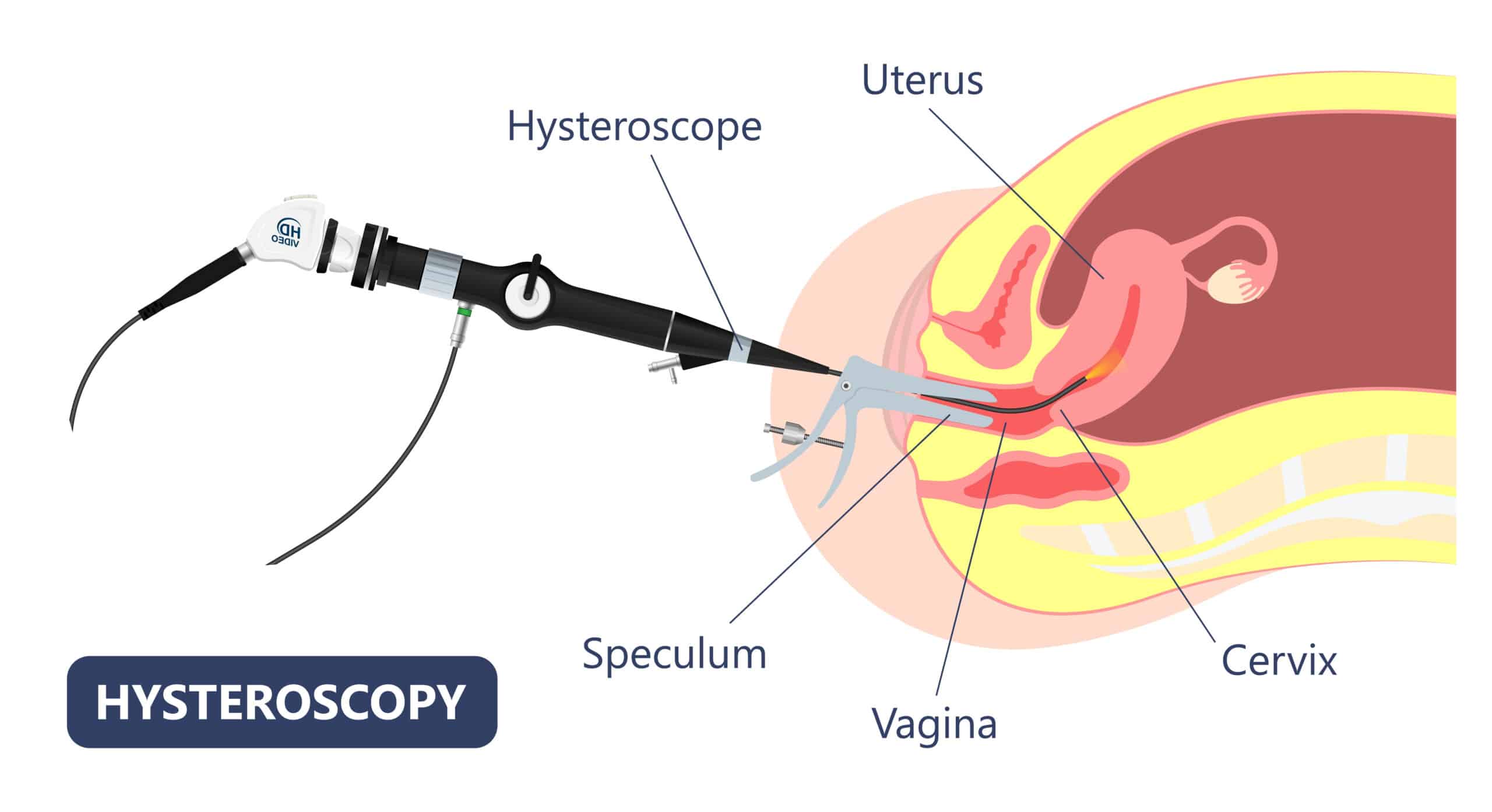ส่องกล้องโพรงมดลูก Hysteroscopy