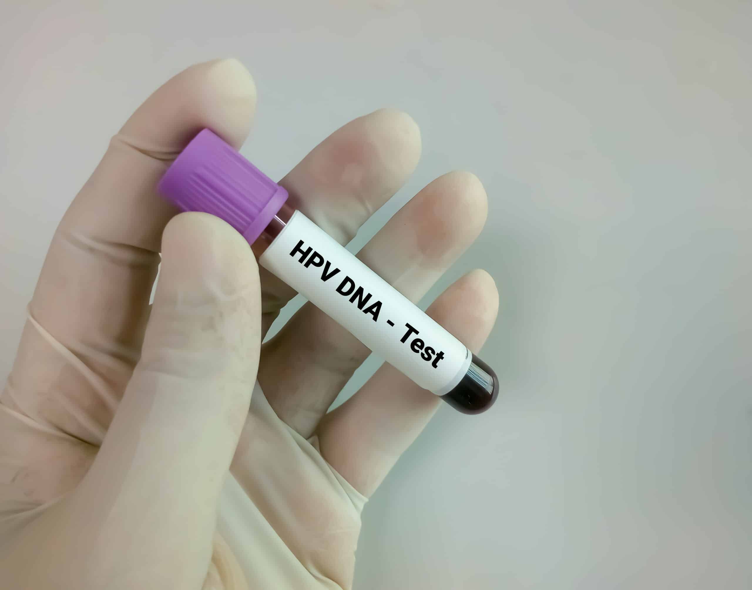 HPV DNA Test การตรวจหาเชื้อ