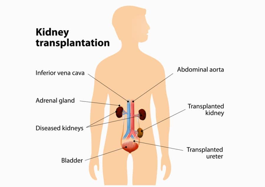เปลี่ยนไต