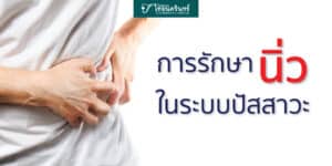 รักษานิ่ว ในระบบปัสสาวะ