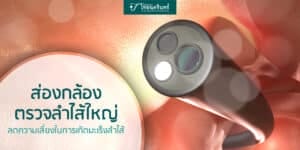 ส่องกล้องลำไส้ใหญ่