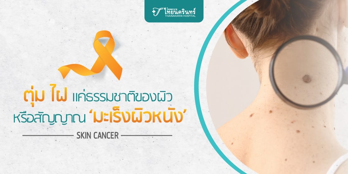 มะเร็งผิวหนัง