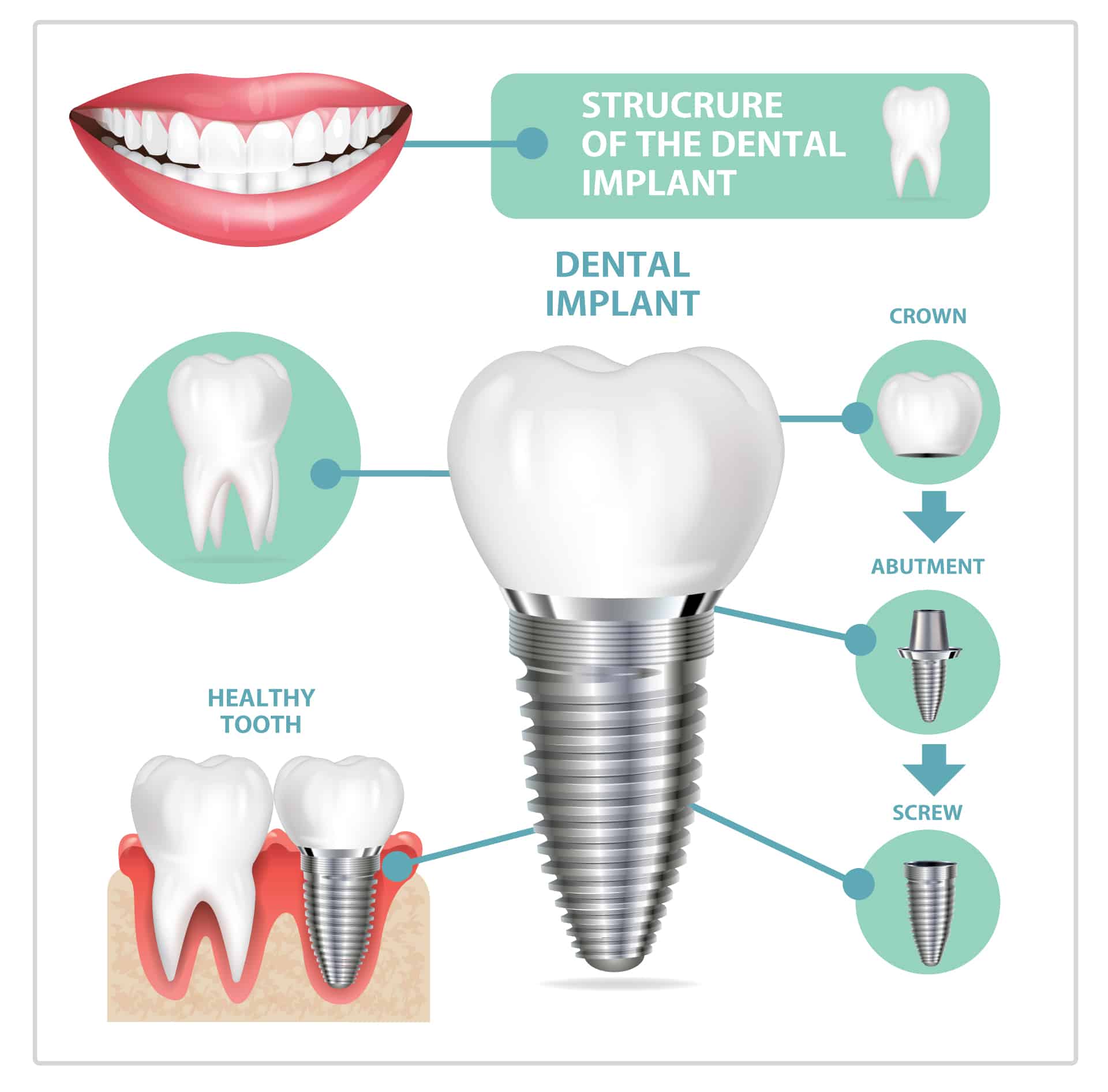 ฝังรากฟันเทียม (Dental Implant)