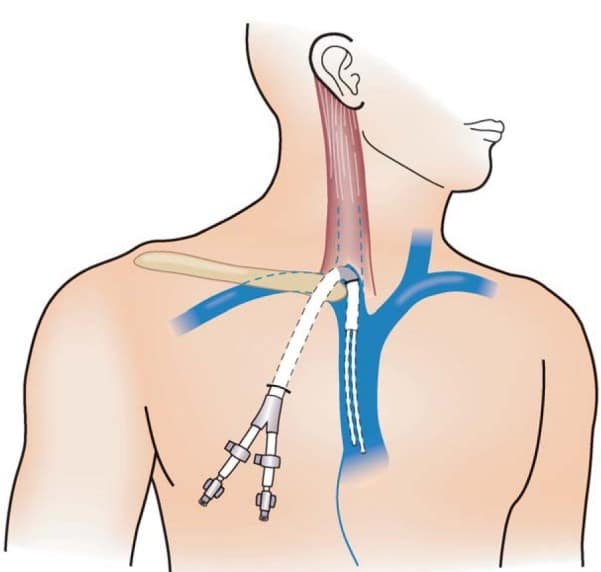 ผ่าตัดเส้นเลือดเพื่อฟอกไต