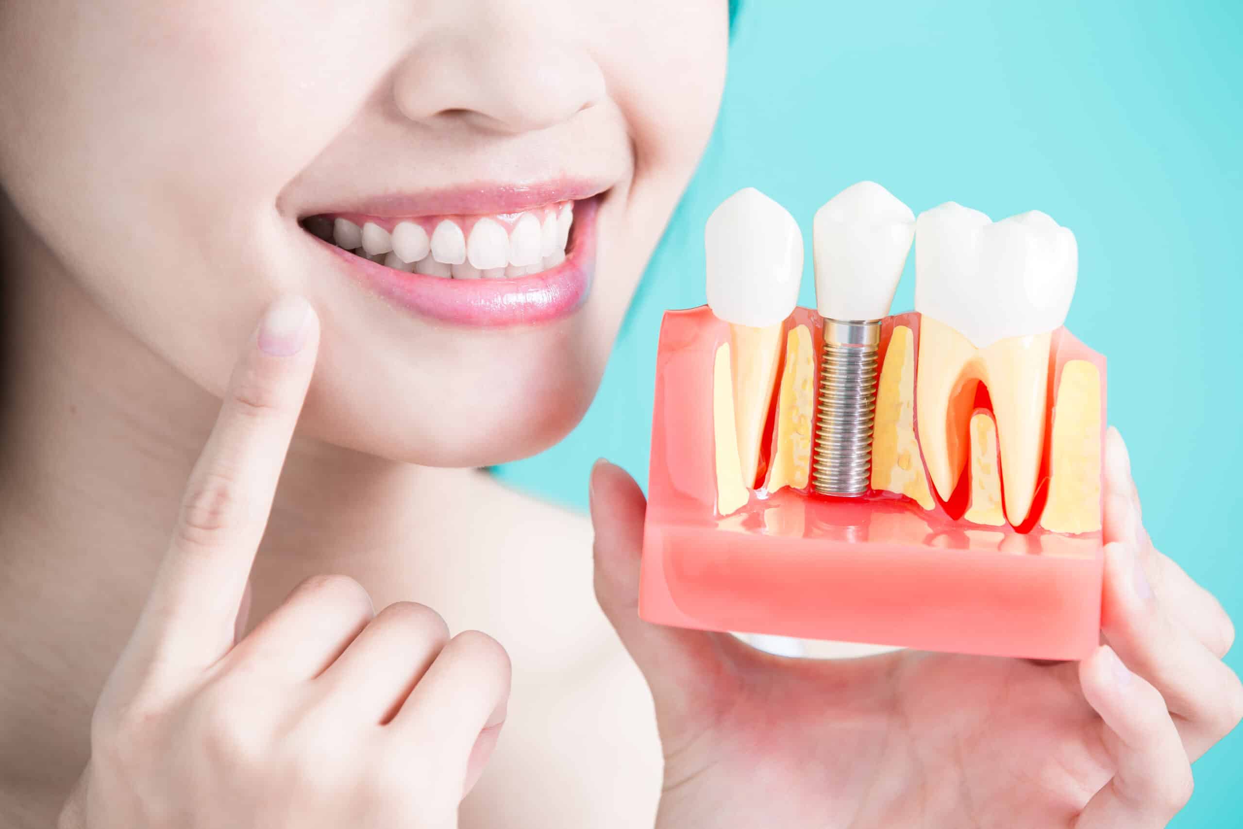 ฝังรากฟันเทียม (Dental Implant)