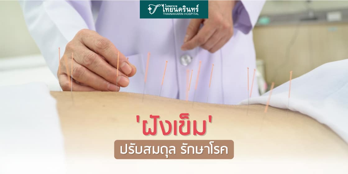 การฝังเข็ม
