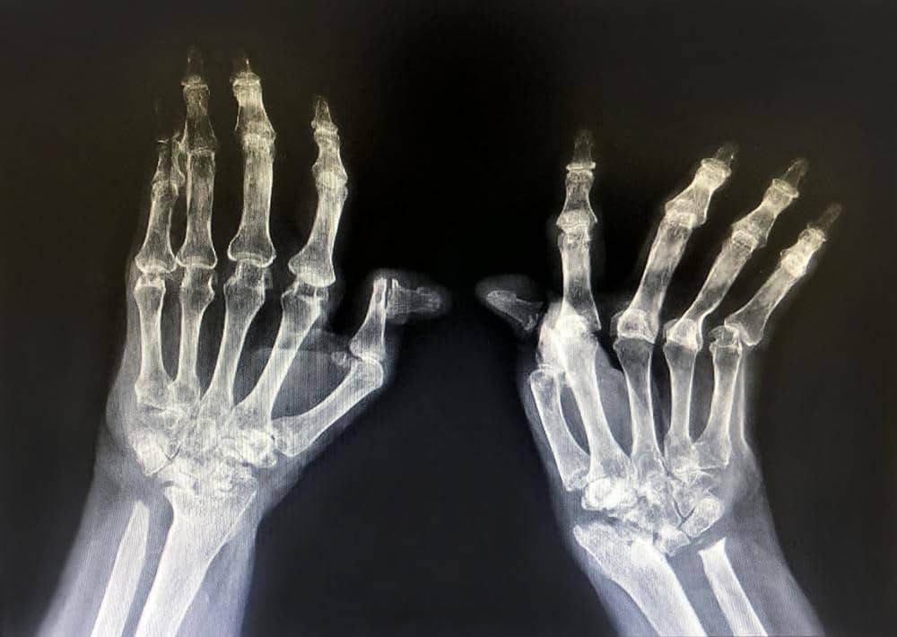 โรครูมาตอยด์ ระยะสุดท้าย