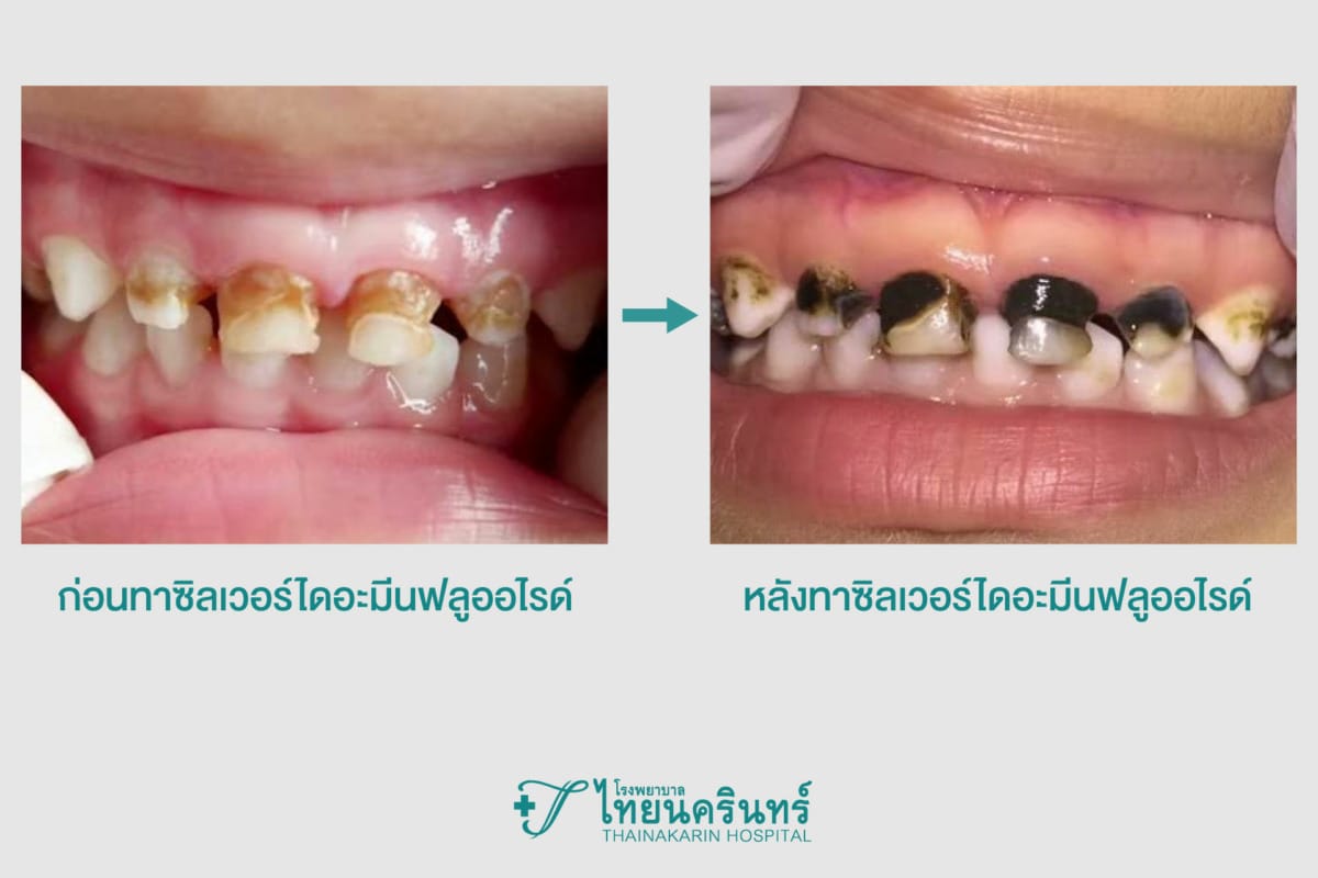 เคลือบฟลูออไรด์ - ซิลเวอร์ไดอะมีนฟลูออไรด์ 