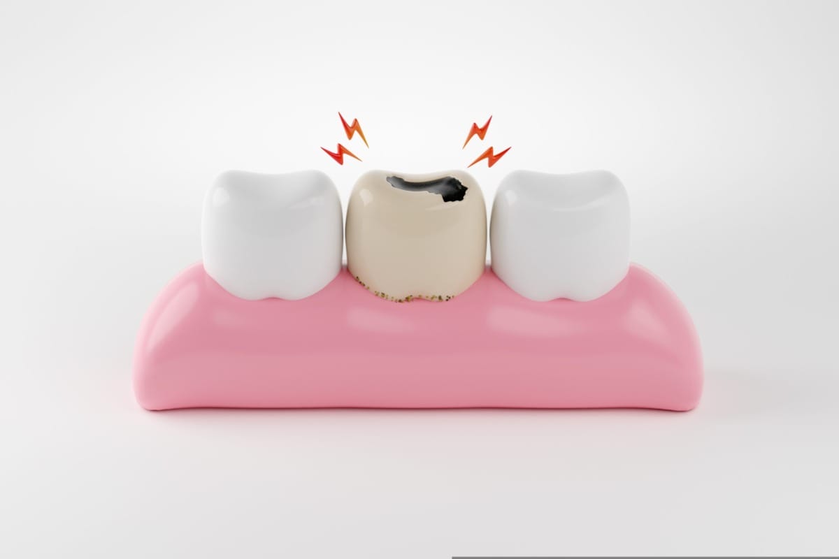 เคลือบฟลูออไรด์ ป้องกันฟันผุ