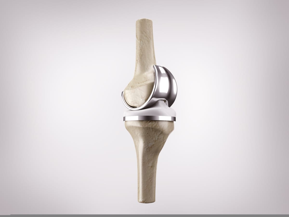 ผ่าตัดเปลี่ยนข้อเข่าเทียม ชีวิตใหม่ของผู้สูงวัย