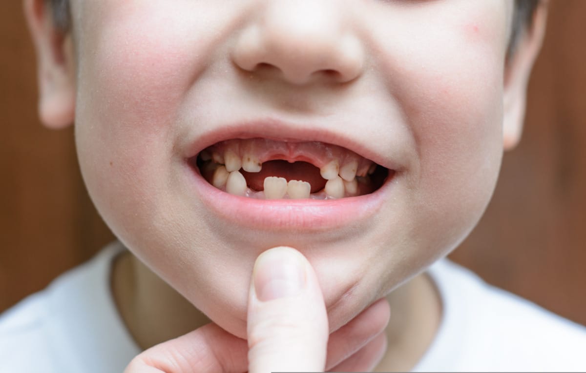 เคลือบฟลูออไรด์ - เด็ก