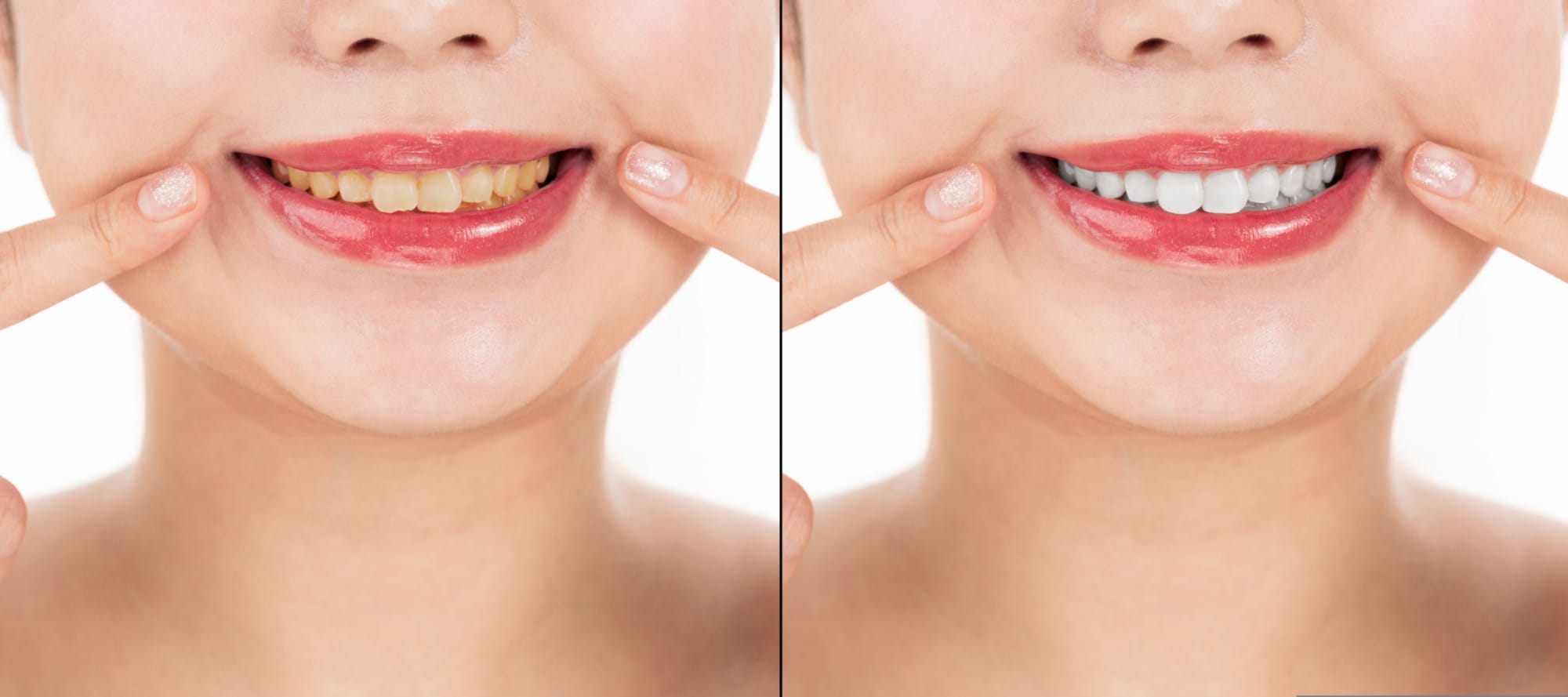 ฟอกสีฟัน ZOOM ฟันขาวขึ้นจริงไหม?